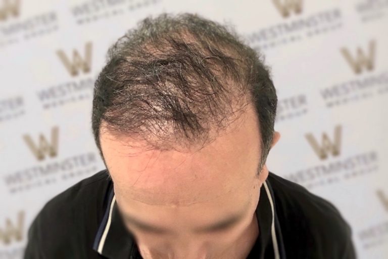 Top view of a man's head showing thinning hair undergoing hair regrowth, with the background featuring a logo wall with repeating 'westminster' text.