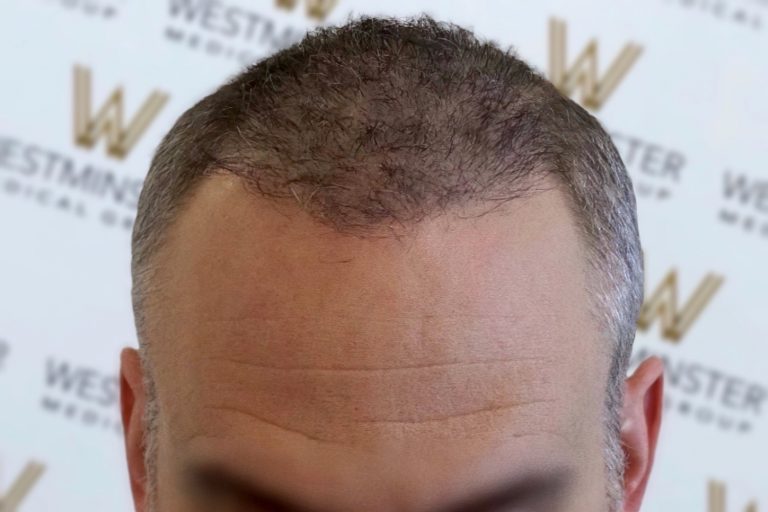 Close-up of a man's head showing the top of his forehead and hair, highlighting a receding hairline with thinning hair and visible scalp. The background features a blurred logo pattern, subtly hint