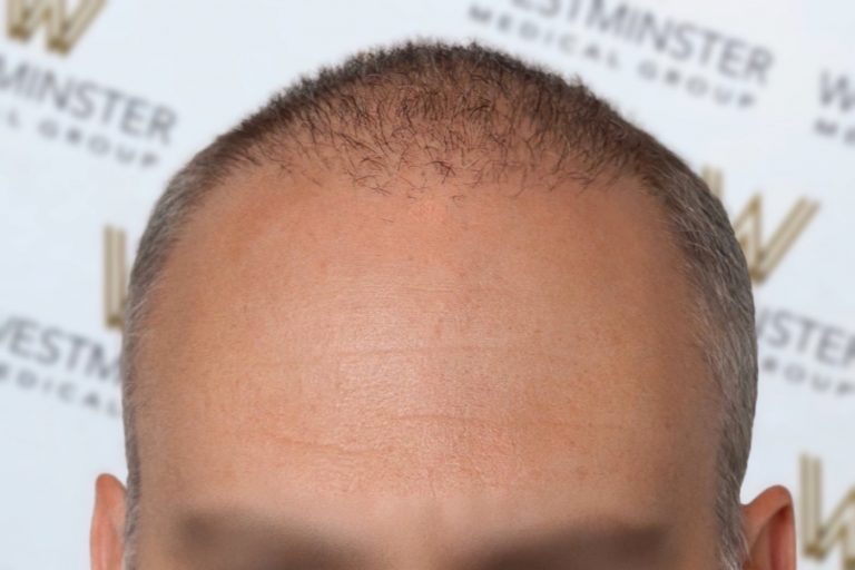 Close-up photo of the top of a man's head showing early stages of hair loss with thinning hair on the crown and a receding hairline.
