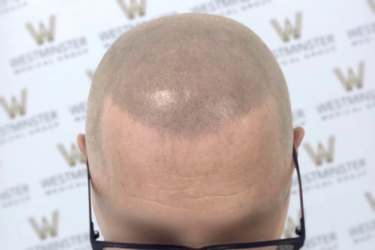 A close-up view of the back of a bald head with glasses hanging over the ears, against a backdrop featuring the "westminster" logo repeated in a pattern, highlighting hair regrowth.