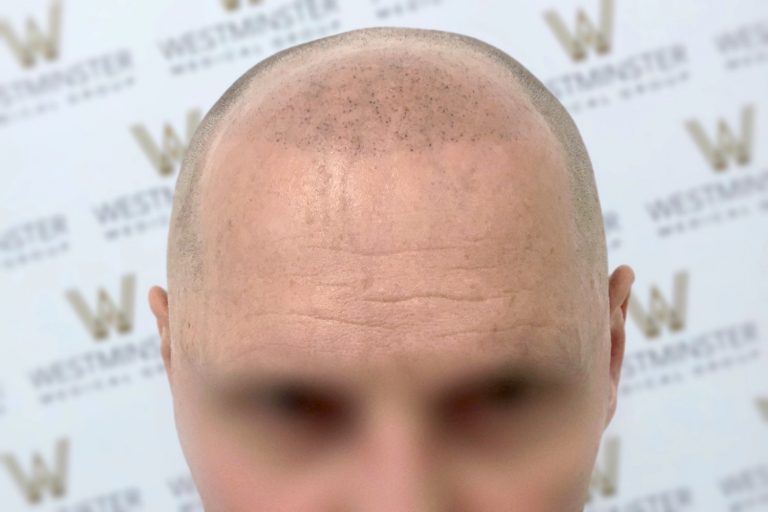Close-up of the top of a bald man's head with a blurred background displaying a logo, focusing on the texture and details of the scalp post-hair implant.