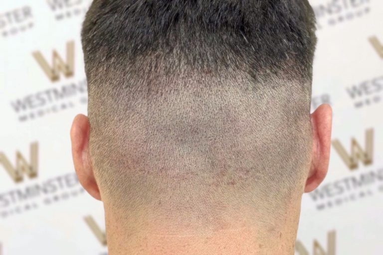 Back view of a person's head showing a closely cropped haircut, with the hair replacement gradually fading into the skin at the neck. The background has a patterned logo wall with text "Westman.