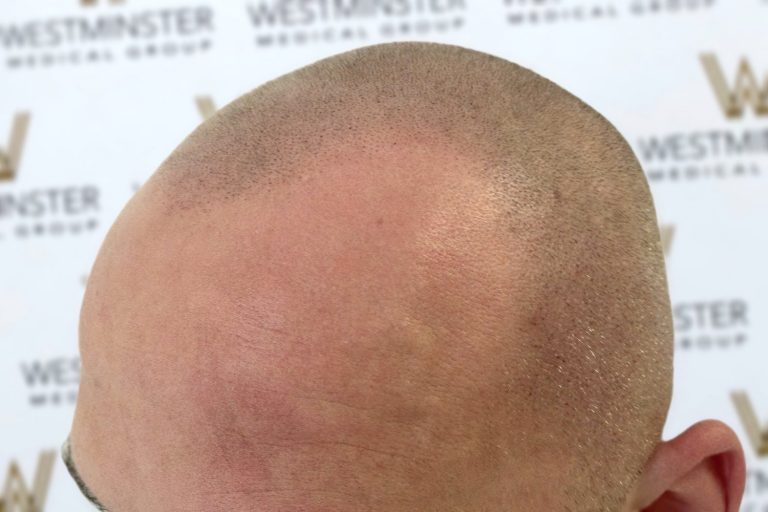 Close-up photo of the top of a bald head after hair implant surgery, showing visible hair follicles and a light reddish area of skin, against a blurred background with repeated logos.