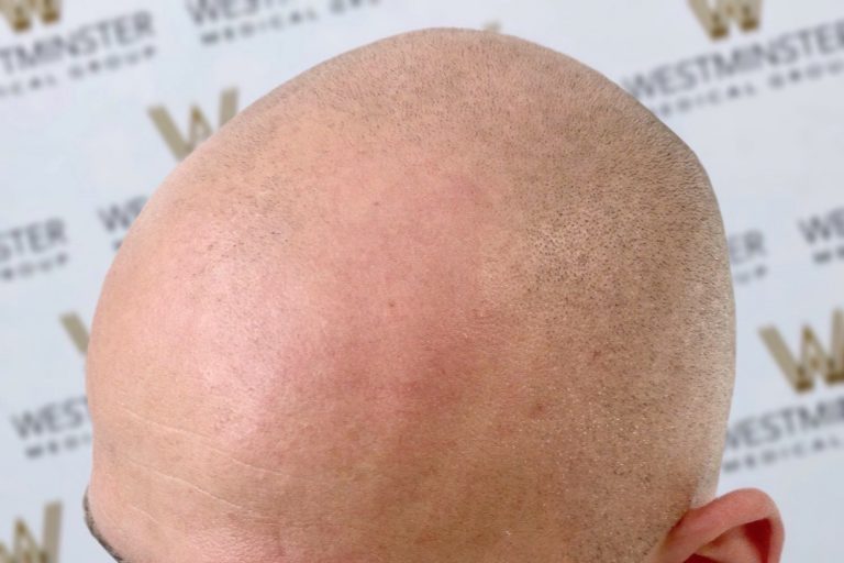 Close-up of the top of a bald person's head with a slight pink hue, set against a background with a blurry westmonster logo. The texture of the scalp and sparsely scattered hair follic