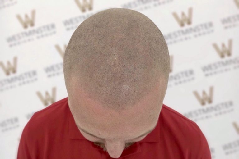 Top view of a bald man's head with hair regrowth visible on the scalp, wearing a red shirt, standing against a backdrop with the Westminster logo repeated.