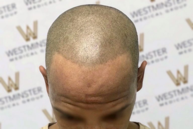Close-up photo of a balding man's head with visible hair growth pattern and a Westminster logo background, emphasizing the potential for hair transplant services.