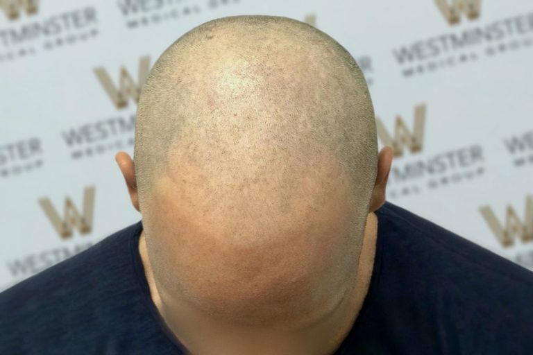 Top view of a bald man's head with visible hair stubble, against a backdrop with the repeated logo "westminster" printed across it, showcasing potential areas for hair implant.
