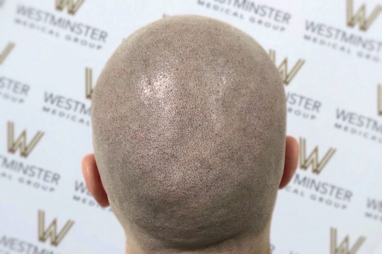 Close-up of the back of a bald head against a backdrop with the repeated logo "Westminster." The scalp, showing signs of female hair loss, has light stubble and a natural skin tone.