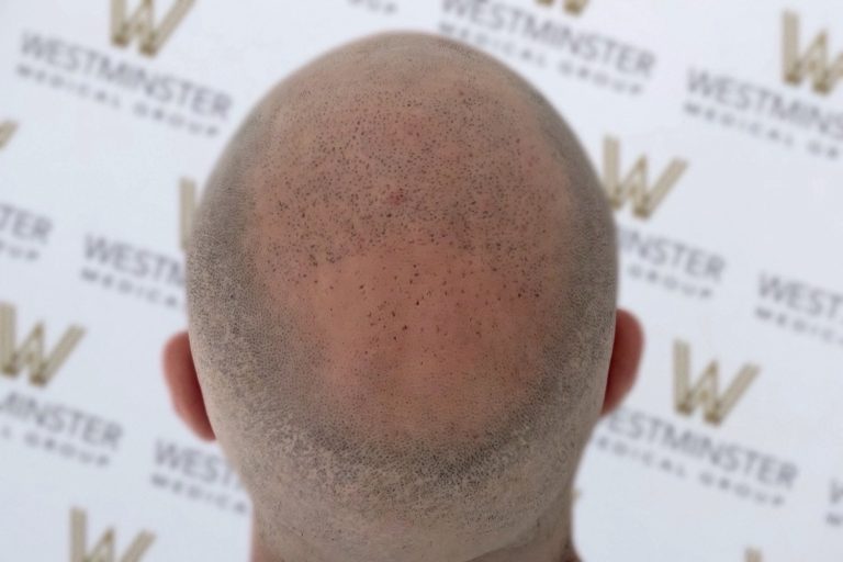 Back view of a bald person's head with light stubble and a few freckles, standing against a backdrop marked repeatedly with "westminster," illustrating hair loss.