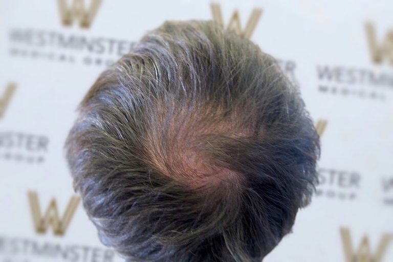 Top of a person's head showing thinning hair, indicative of female hair loss, with a focus on the scalp. The background has blurry text reading "Westminster" repeated on a wall.