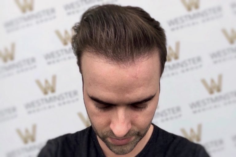 A close-up image of a man looking downwards, focusing on his hair implant. He is in front of a backdrop with the repeated logo "W" and the word "Westminster.