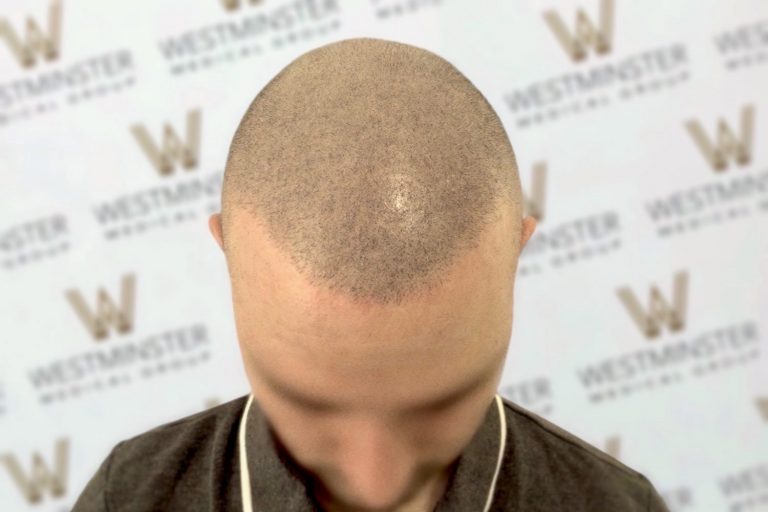Top view of a person's balding head with sparse hair, indicative of male pattern baldness, set against a branded backdrop with repetitive logos.