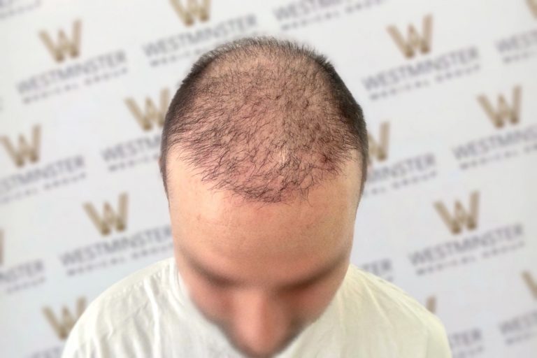 Close-up view of a man's head showing early stages of hair loss on the top and front areas, against a background with a repeated logo pattern for hair replacement services.