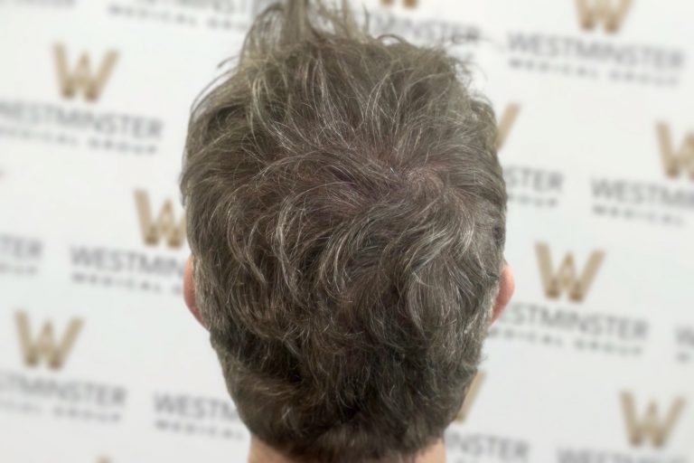 Back view of a person's head showing disheveled grey hair with signs of female hair loss against a background with repeated logos of "Westminster.