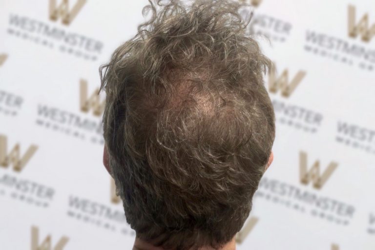 A close-up image of the back of a person's head showing messy grey hair with a visible bald spot indicative of male pattern baldness, against a background with a repetitive "westminster" logo pattern
