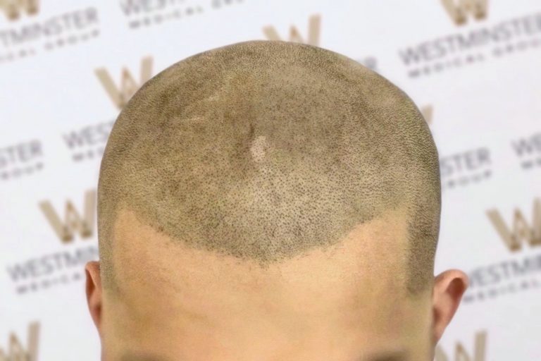 Close-up of the top of a person's head showing a unique hair pattern with a shaved design resembling an inverted heart, set against a backdrop with the "westmaster" logo. This image highlights the