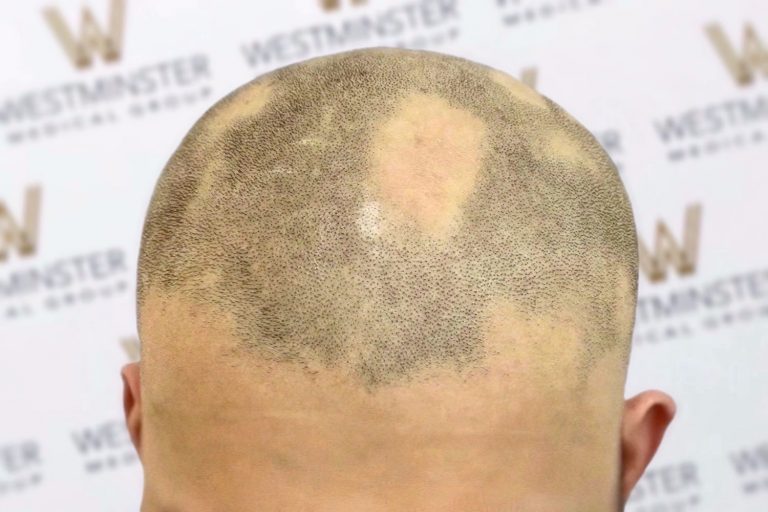 Close-up of the back of a balding man's head with sparse hair growth and a visible bald spot, set against a background with a repeating logo pattern advertising hair regrowth.