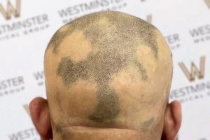 A close-up photo of the back of a bald head with a unique pattern of hair regrowth resembling a map, set against a background with repeated "westminster" logos.
