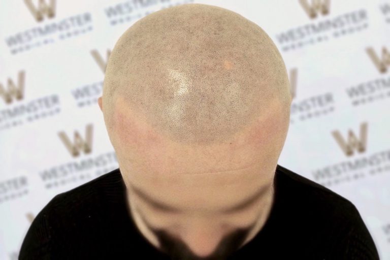 Close-up photo of a person's bald head seen from the back, illustrating male pattern baldness. The background features a repeating logo. The focus is on the texture and details of the scalp.
