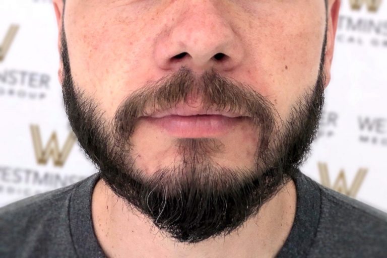 Close-up photo of a man's lower face showing his mustache and beard, highlighting male pattern baldness, against a backdrop with the Westminster Kennel Club logo.