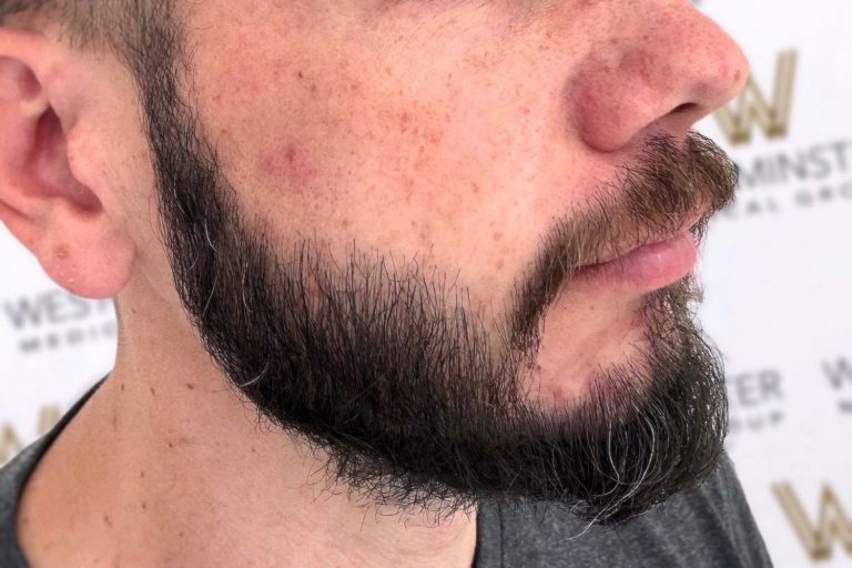 Close-up view of a man's face from the side, showing his dark beard and sideburns, thinning hair indicative of male pattern baldness, a visible earring, and a background with