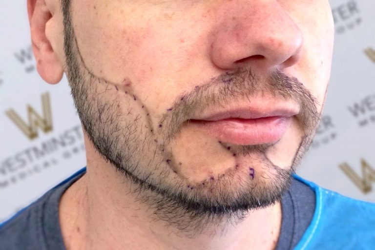 Close-up of a man's lower face showing a beard and hair implant scars on his cheek and jawline.