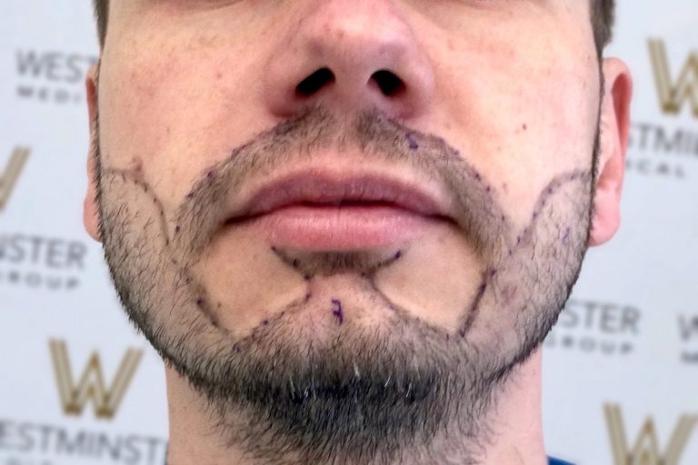 Close-up of a man's lower face showing a beard with markings drawn on it, possibly for a hair implant procedure, against a blurred background with logos.