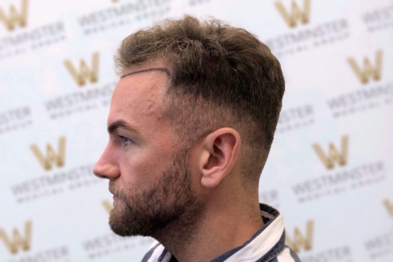 Profile view of a man with a modern undercut hairstyle following hair replacement surgery and a short beard, standing against a backdrop featuring a repeated logo pattern.