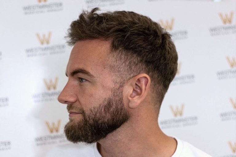 Side profile of a man with a styled beard and trendy, short haircut, displaying hair regrowth, standing against a backdrop with the West Ham United logo.