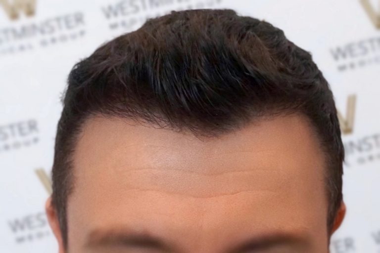 Close-up of the upper part of a person's face, showing eyebrows and a styled, dark hairline affected by male pattern baldness against a background with a logo pattern.