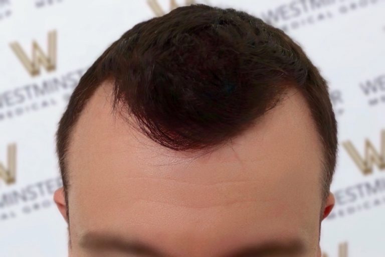 Close-up of a man's forehead and hairline, featuring dark hair styled upwards after a hair implant, with no visible face except the forehead, against a branded background.