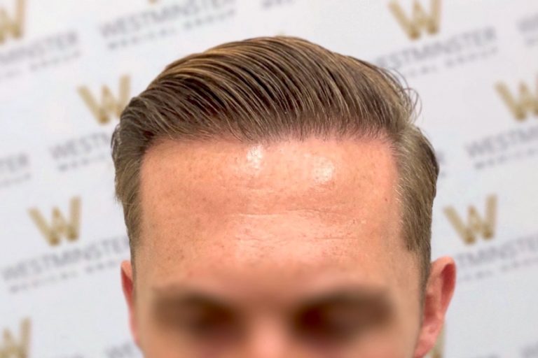 Close-up of a person's forehead exhibiting signs of male pattern baldness and styled hair, with the face blurred, against a backdrop featuring a logo-patterned wall.
