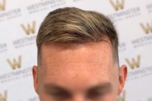 Close-up of a man's hairstyle with a neatly groomed, side-parted, swept-back haircut showing signs of male pattern baldness. The background shows a blurry "Westminster" logo. The