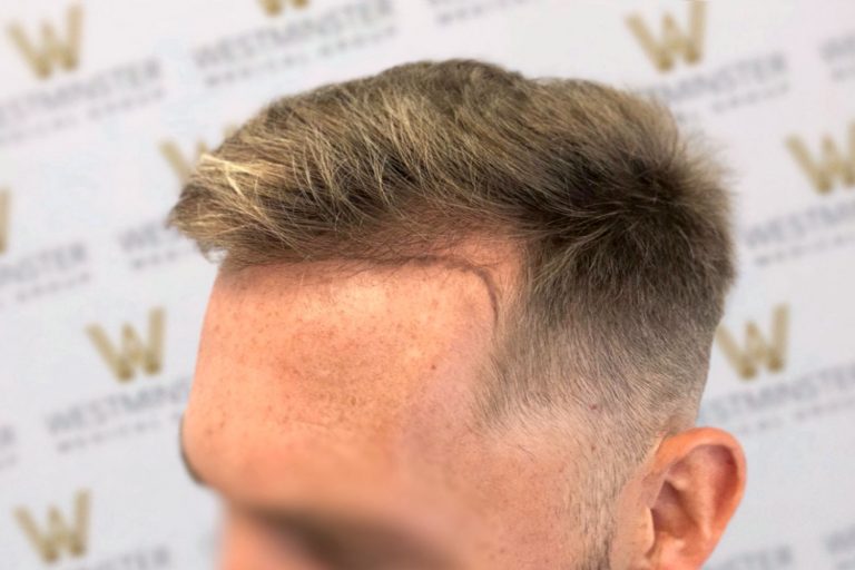 fue hair transplant london