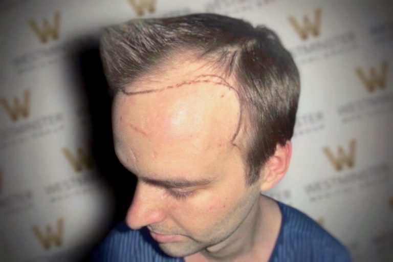 A man with marked lines on his scalp possibly for a hair implant procedure, standing against a backdrop with a repetitive "w" pattern.