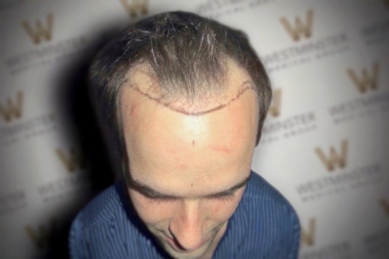 Top view of a man's head showing advanced hair loss with a distinct horseshoe pattern of remaining hair, ideal for showcasing hair transplant services on a branded background.