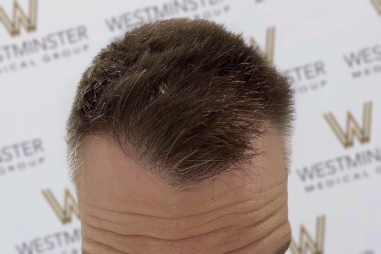 Close-up of a person's head showing male pattern baldness on the scalp, set against a background with the Westminster Kennel Club logo repeated.