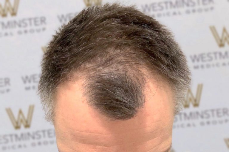 Top view of a person's head showcasing male pattern baldness surrounded by black hair, with a blurred background featuring a logo.