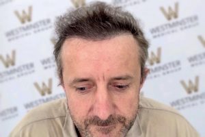 A close-up of a middle-aged man with a thoughtful expression, looking down. He has dark hair from a recent hair implant and a beard. The background features a repeated logo with the letter 'W