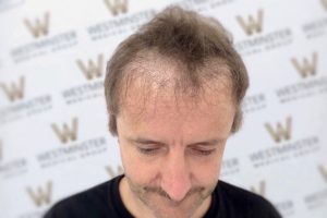 A middle-aged man with male pattern baldness looks down, standing against a background marked with multiple logos of the letter "w" inside circular designs.