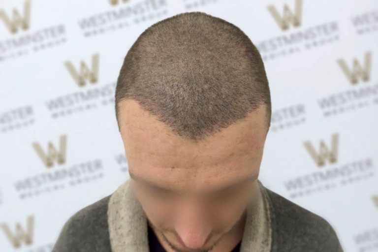 Top view of a person's head with a unique, sharp triangular hairline pattern on the back, indicative of male pattern baldness, standing against a backdrop with multiple 'westminster' logos.