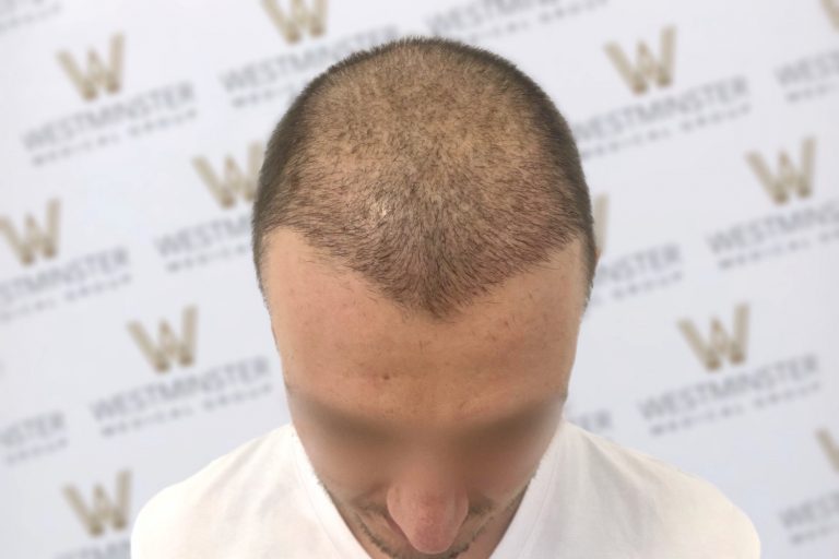 Top-down view of a person's head showing early stages of hair regrowth after male pattern baldness, against a backdrop with a repeated "w" logo. The person has short, sparse hair on