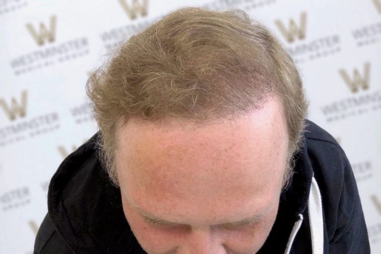Top view of a man's head showing thinning hair and a balding crown, possibly in need of hair replacement, with a background of a wall featuring the Westminster Hotel logo.