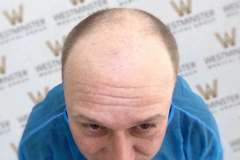 Close-up view of a bald man's head showing signs of hair replacement on the crown, with a background featuring a wall with a repeated logo pattern.