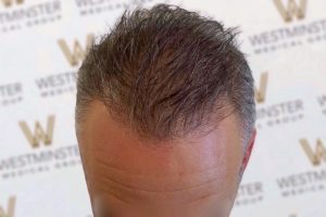 Close-up of the top of a person's head showing dark brown hair with signs of male pattern baldness. The background displays a repeated pattern of a logo, likely from an event.