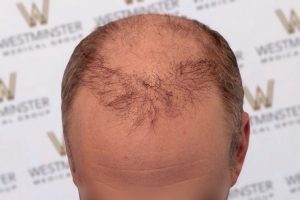 Top view of a balding man's head with sparse, thin hair on the crown, showing signs of male pattern baldness, against a background featuring a westmeister logo pattern.