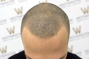 Top view of a person’s head showing early stages of hair regrowth with a distinct bald patch at the crown. The background features a pattern with the word "Westminster.