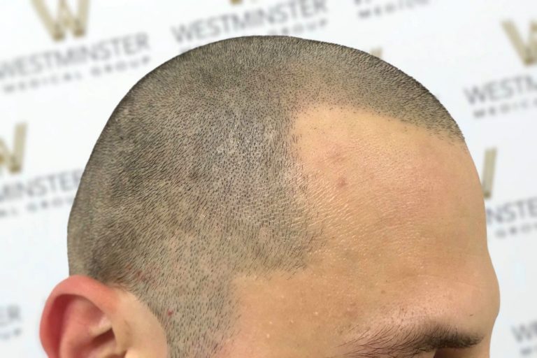 Close-up of a person's head showing a partially shaved scalp with visible hair stubble and a clear demarcation line, set against a backdrop featuring the "westminster" logo, hinting at