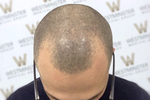 Top view of a man's head showing early stages of male pattern baldness, with thinning hair on the crown and a slightly receding hairline, set against a branded background.