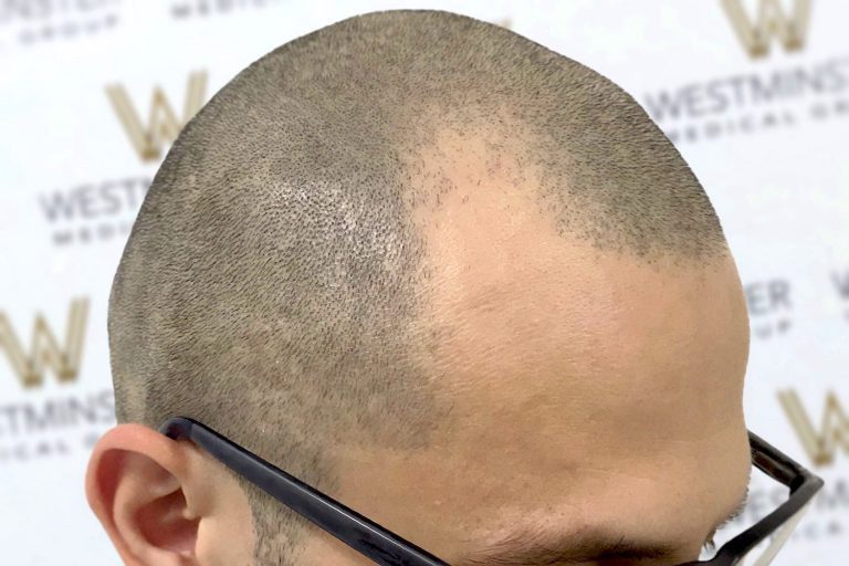 Close-up of the top of a man's head showing early stages of male pattern baldness with thinning hair, primarily on the crown area. The background features a logo with text "Westminster.